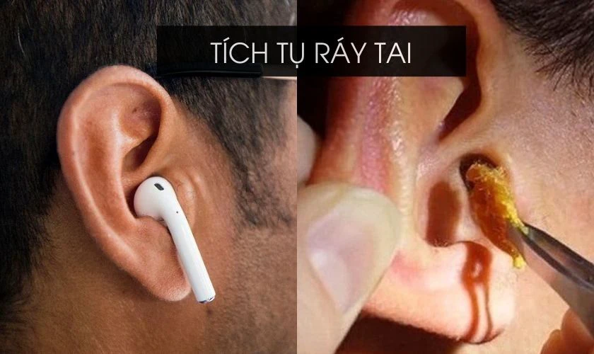 Gây tích tụ nhiều ráy tai khi đeo tai nghe thường xuyên