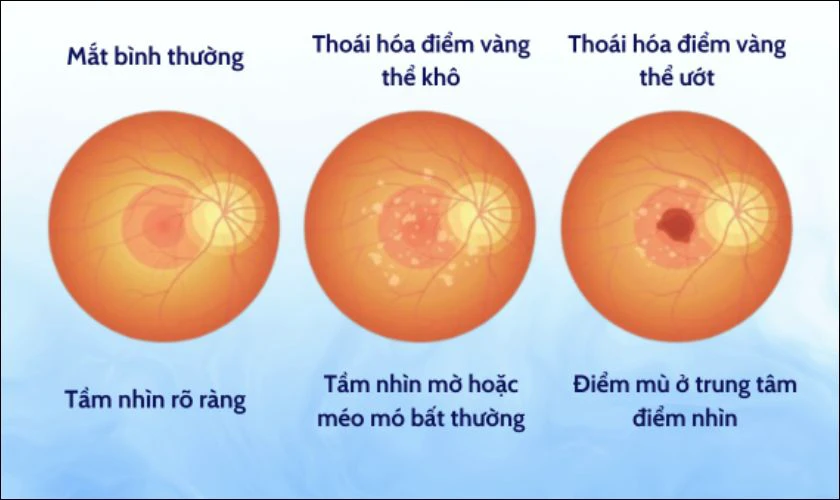 Sử dụng điện thoại lâu liên tục có thể gây thoái hóa điểm vàng