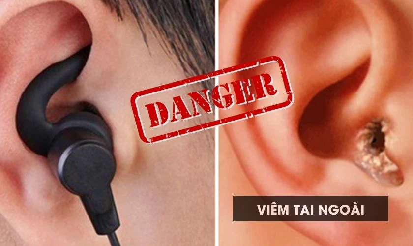 Đeo tai nghe khi ngủ l&acirc;u ng&agrave;y khiến cho v&ugrave;ng da quanh ống tai bị b&agrave;o m&ograve;n